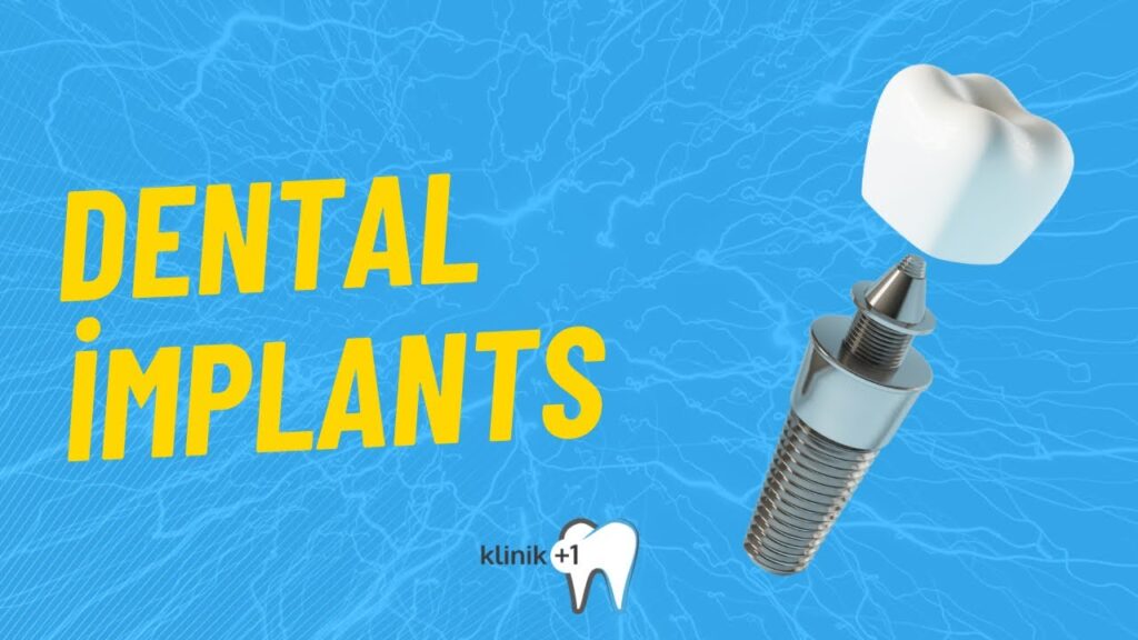 Dental Implants