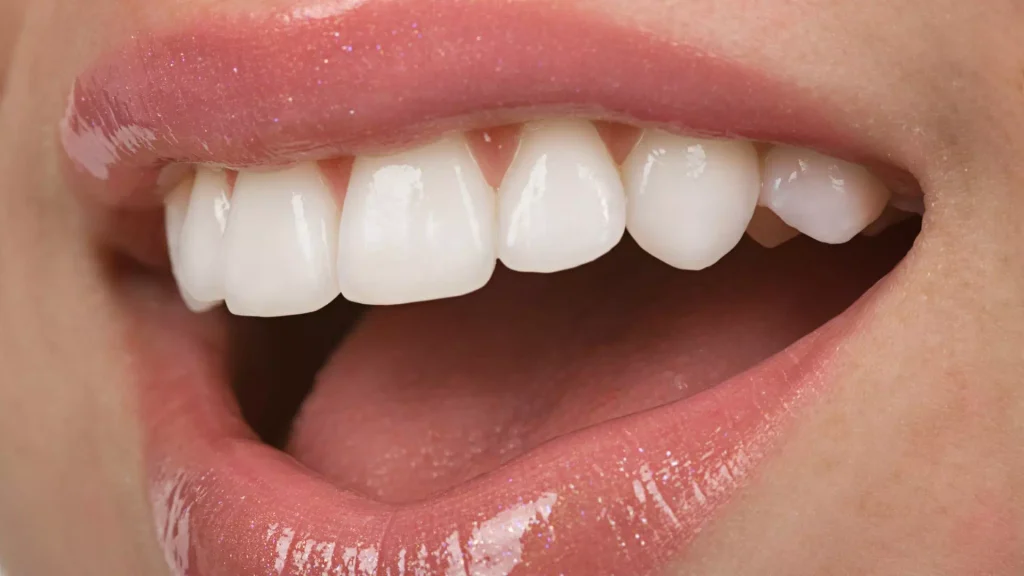 Veneers