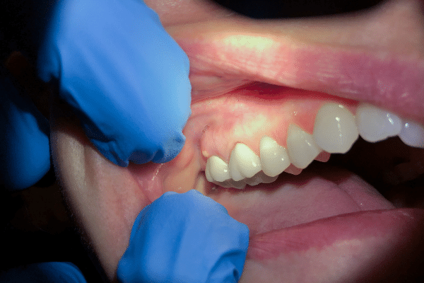 İltihaplı Dişe Kanal Tedavisi Yapılır Mı ?
