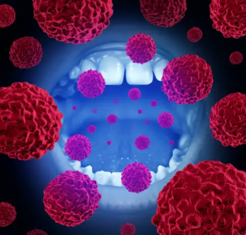 Ağız Kanseri Görseli 1