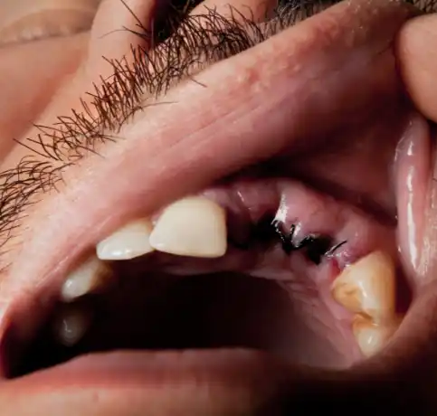 Ağız Kanseri Görseli 2