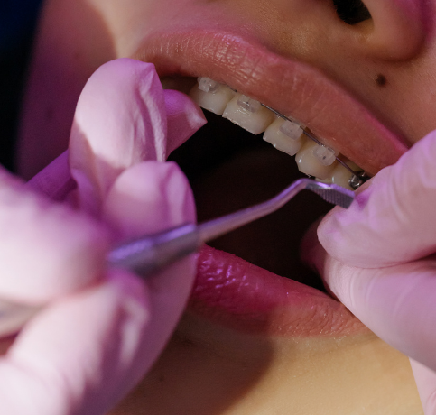 ortodontik-tedavi