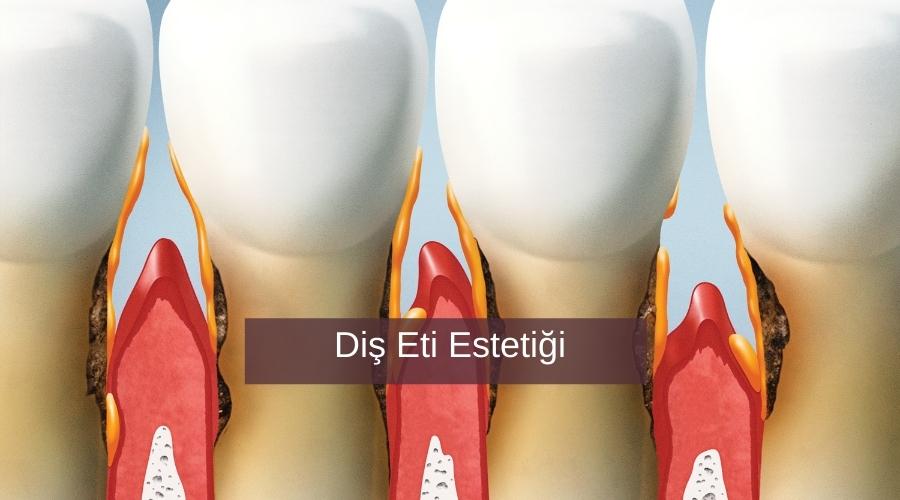 Diş Eti Estetiği Klinik Arti Bir