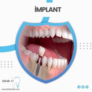 Ön Dişe İmplant Yapılır Mı ? 1 Ön Dişe İmplant Yapılır Mı ?