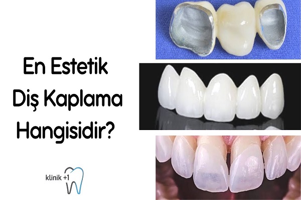En Estetik Diş Kaplama Yöntemi Hangisidir ? 1 En estetik diş kaplama yöntemi hangisidir