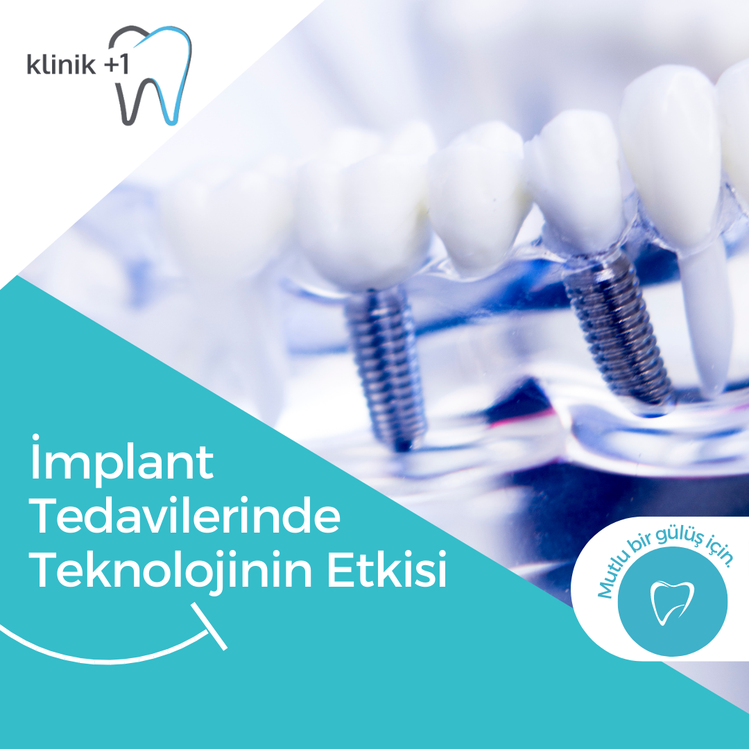 İmplant Tedavilerinde Teknolojinin Etkisi