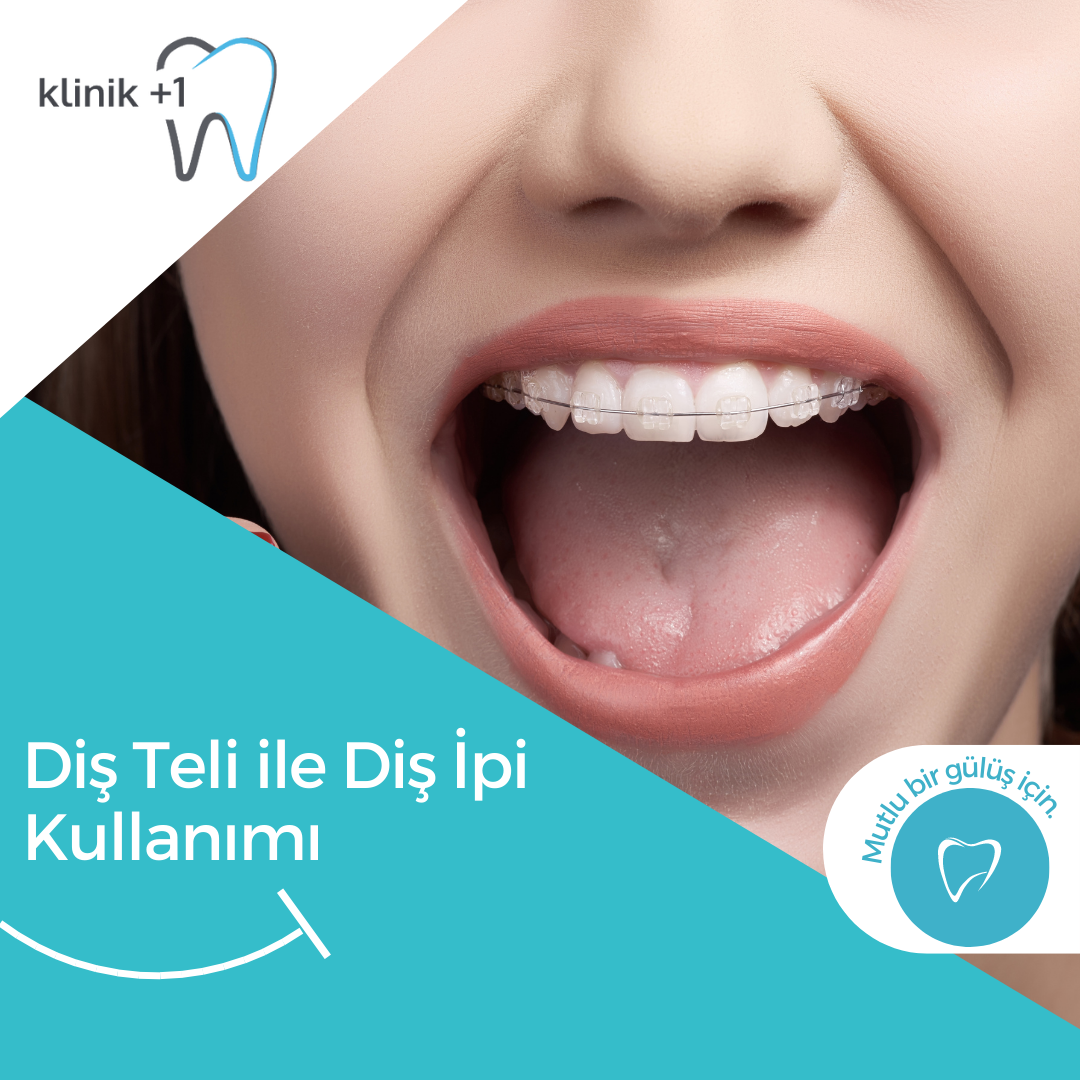 Diş Teli ile Diş İpi Kullanımı