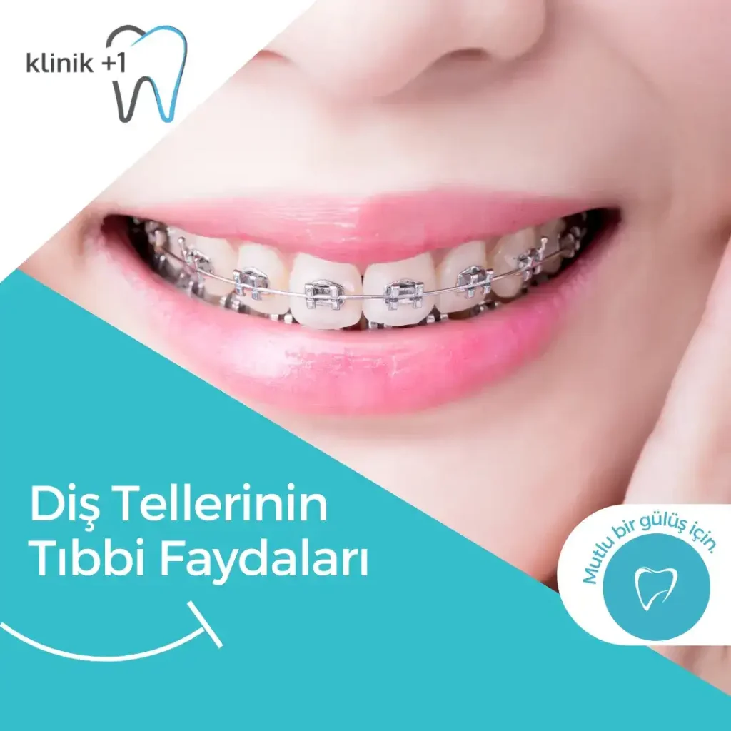 Diş Tellerinin Tıbbi Faydaları 10 Diş tellerinin tıbbi faydaları