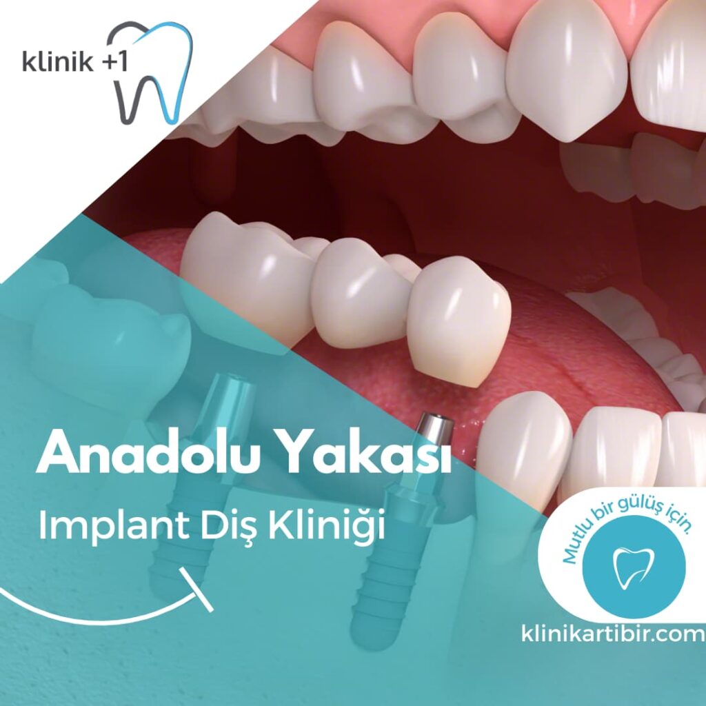 Anadolu Yakası Implant Kliniği 2 Anadolu Yakası Implant Kliniği