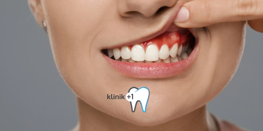 Diş Eti İltihabı Nedir ? Diş Eti İltihabına Ne İyi Gelir? 4 Diş Eti İltihabı
