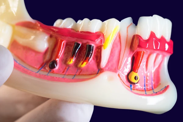 Diş Çürüğü Nasıl Anlaşılır