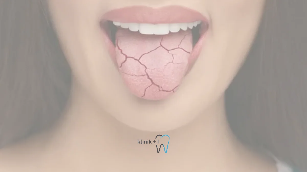 Agiz Kurulugu Kserostomi