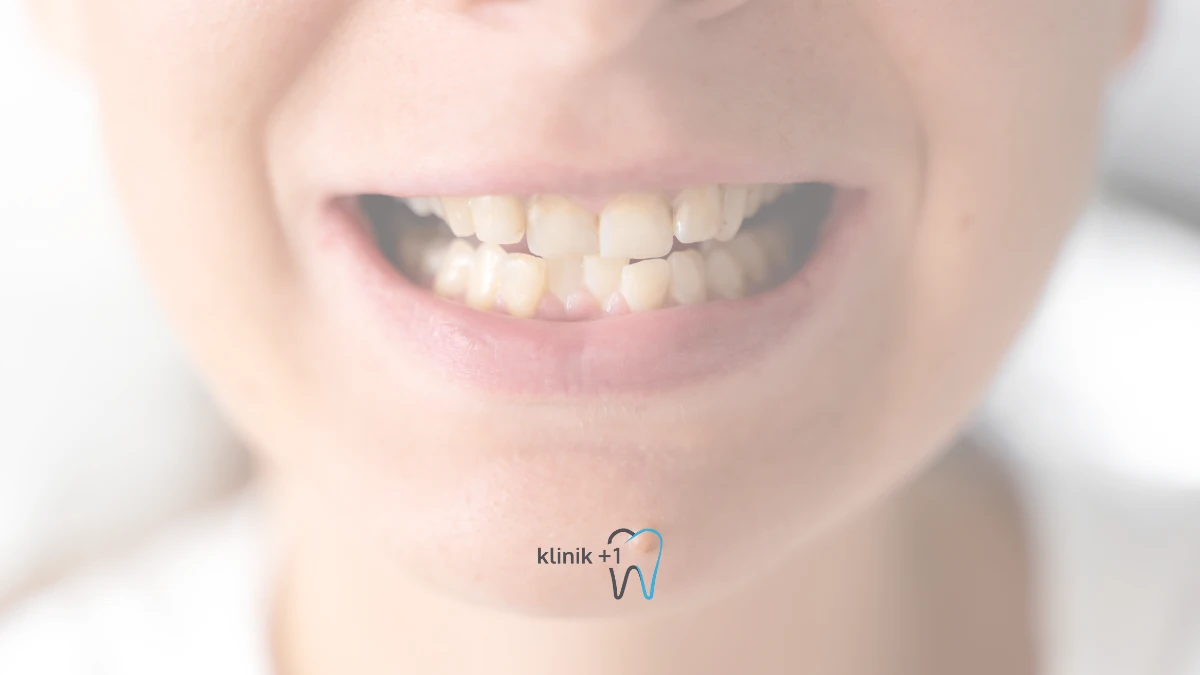 Carpik Dis Neden Olur