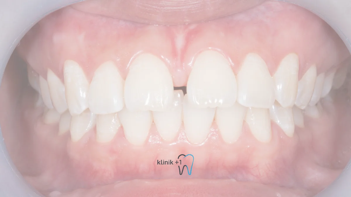 Diastema Ayrik Dis Nedir