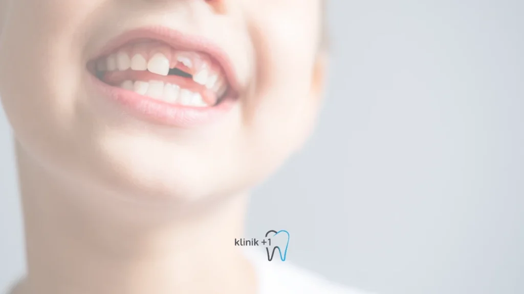 Süt Diş Dökülmesi